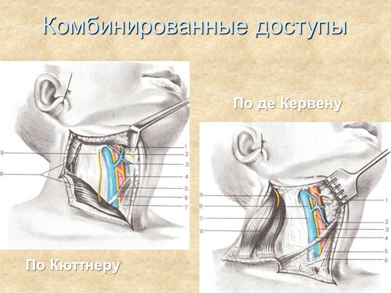 Комбинированные доступы По де Кервену По Кюттнеру